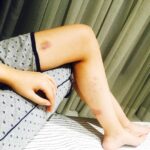 Kriti Sanon Instagram – Bruised n how! Looks like an artwork of bruises! 🙈 #NoPainNoGain #Raabta