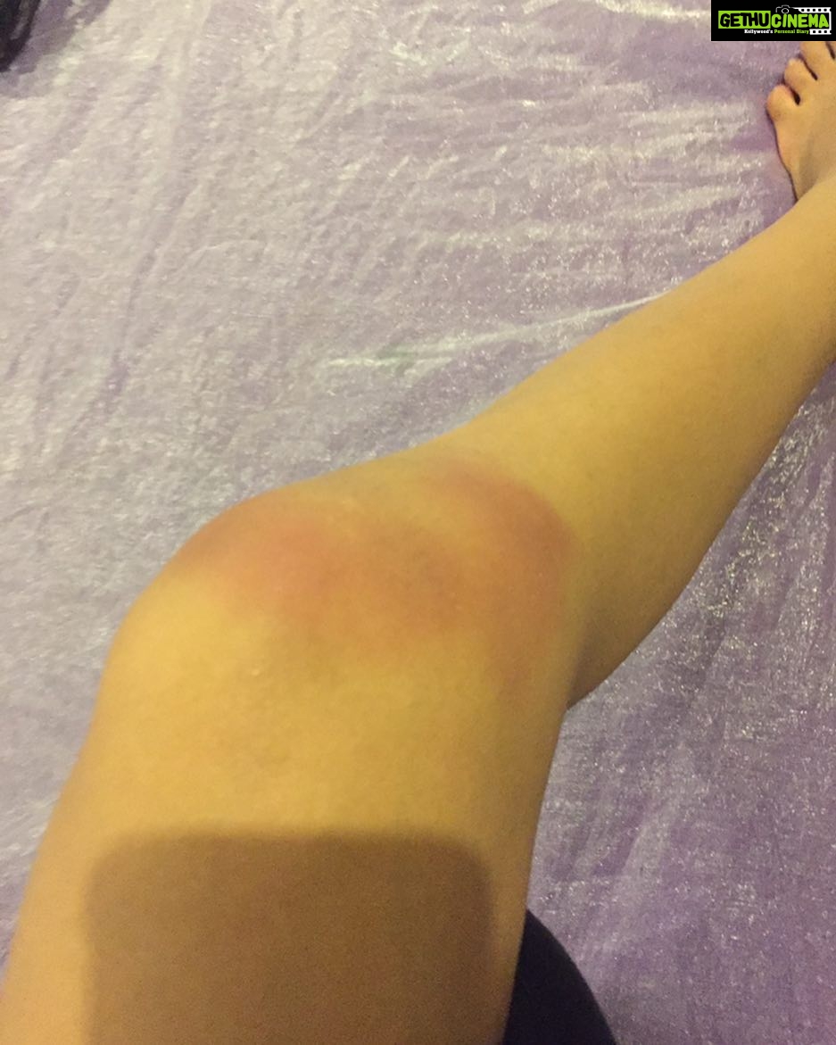 Nidhhi Agerwal Instagram - I know this is not a nice picture to look at.. but this was my second day of shoot and the second day of #shakekaraan when I got injured and dint tell anybody about it.. #worthit #munnamichael #gottadowhatyougottado