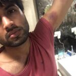 Vijay Deverakonda Instagram - Celebrate your Bruises! Because In life nothing comes easy.