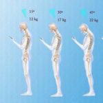 Yuthan Balaji Instagram – Did you know that your head weighs around 04 or 05 kg? All supported by some pretty small bones in your neck! A Quick look at biomechanic of the body shows that when you are slouched over a phone at 45 degree angle.its equivalent to placing 22kg of stress on the neck! This often translates into headache and pain down the back….consider your posture!

#health #tips #ortho #head #neck #happy #hair  #hot #cool #fashion #friends #smile #follow4follow #like4like #instamood #family #nofilter #amazing #photooftheday #my #nocrop
