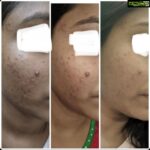 Chinmayi Instagram - Before and Afters with @isleofskin Swipe to see results after 90 days of consistent use. “Hey, hi! I've been using Isle of skin products since September. Thanks to you my skin has never felt better before! 😊❤️”