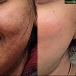 Chinmayi Instagram - Before and Afters with @isleofskin :) “Hi Chinmayi, I just want to take a moment of your time and appreciate how you and @isleofskin have changed my skin! I know I have thanked you before but I literally cannot thank enough. It’s been almost a year that I’m following the double cleanse routine. I visited my family in India after 2 years and I kid you not, literally my mom was so happy looking at my skin ‘cause that’s how my skin was before puberty. Thanks soooooo much.”