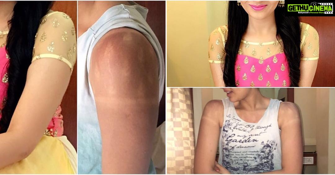 Sreemukhi Instagram - Okay now this is what has happened to me and that's why I had to wear a cape yesterday! Warangal event after effects! TAN BURNS! The most horrifying thing that has happened to me! No regrets when it happens during work! #tanburns #aftereffects #horrific #noregrets #gettinglighter 😔🙁😒