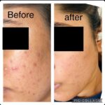 Chinmayi Instagram – Before and afters with @isleofskin