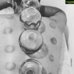 Shanthanu Bhagyaraj Instagram - #HijamaClinic #CuppingTherapy Feeing so relieved after their treatment ! This is the place u need to go to when u have muscle aches and other injuries ! Do check them out ! Thank you @drhalinarajiya www.hijamaclinic.in 😊💛👌👍🏻 n thank you @deeptiakki for showing me the right place 😊
