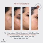 Chinmayi Instagram - Our magic is a process and we beleive in it✨ #RealPeople #RealResults #ibeleiveisleofskin #realpeoplerealresults #selflovematters #isleofskin #isleofskincare #isleofskinproducts #isleofskinoriginals #isleofskintips #skincareroutine #skincaretips #isleofskinbeautytips #kbeauty #kbeautyindia #koreanbeauty #koreanbeautycare #koreanskincare #kbeautyskincare