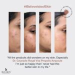 Chinmayi Instagram – Our magic is a process and we beleive in it✨

#RealPeople #RealResults
#ibeleiveisleofskin #realpeoplerealresults #selflovematters #isleofskin #isleofskincare  #isleofskinproducts #isleofskinoriginals  #isleofskintips #skincareroutine #skincaretips #isleofskinbeautytips #kbeauty #kbeautyindia #koreanbeauty #koreanbeautycare #koreanskincare #kbeautyskincare