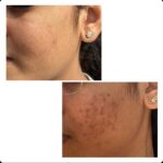 Chinmayi Instagram – An @isleofskin x @deepskindialogues x @dr.kumudhini_skindoc transformation.