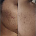 Chinmayi Instagram - An @isleofskin before and after :)