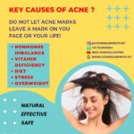 Gurleen Chopra Instagram – KEY CAUSES OF ACNE ? 
– HORMONAL ACNE
-VITAMIN DEFICIENCY 
-DIET 
-STRESS
-OVER WEIGHT 
.
Contact team
@counsellingwith.gc
@igurleenchopra
.
.
.
.
.
.
.
#hormonalimbalance #facialhair #facialhairdiet #imbalanace #hairloss #weightgain #acne #pimples #healthydiet #homemade #homemadediet #naturaldiet #counsellingwithgc #igurleenchopra #youtubeimgc
