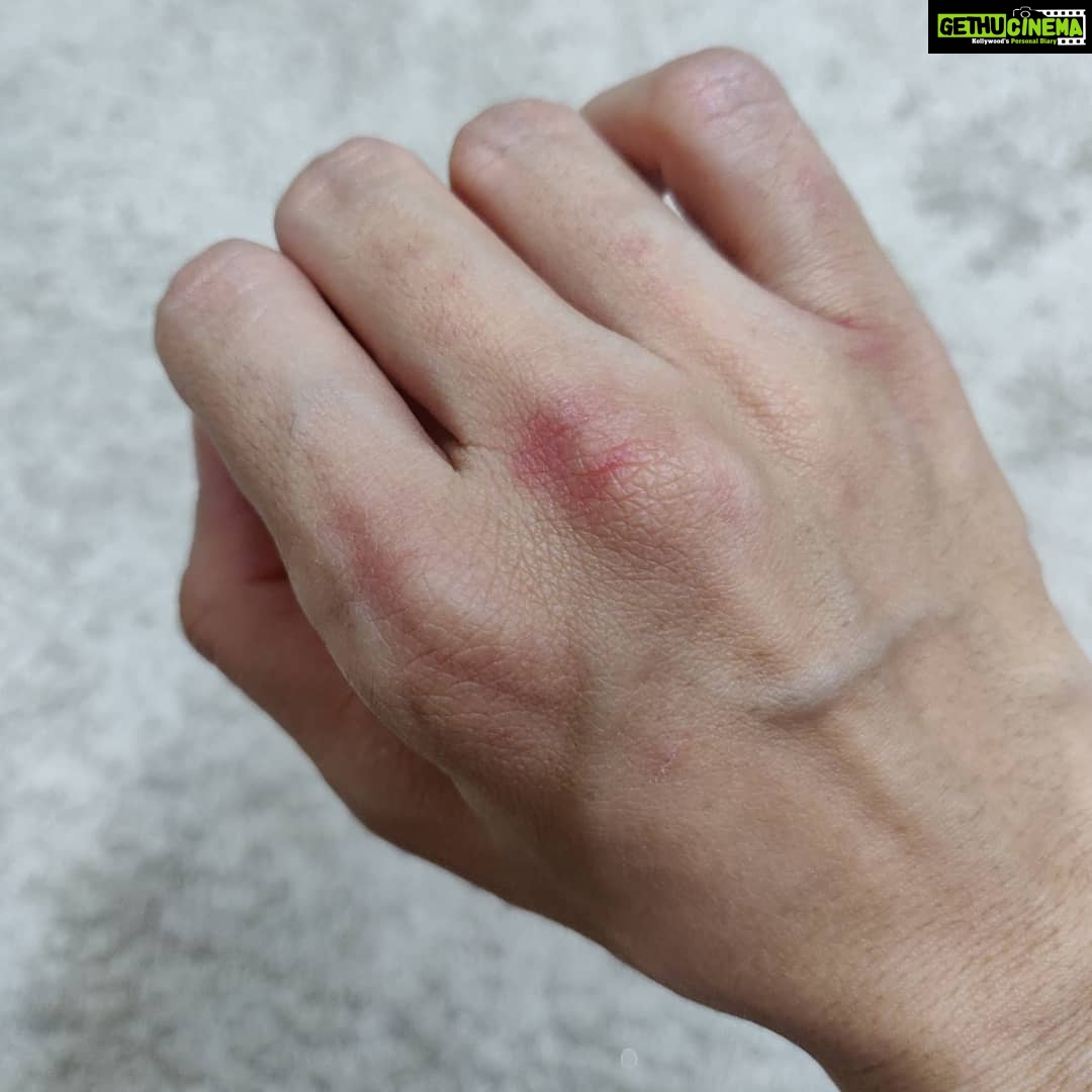 Tina Desai Instagram - Day 1 of boxing lessons. I got these bruises inspite of wearing boxing gloves and also a cloth wrapping beneath that. I'm so proud of it! Lol!!!