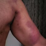 Arun Vijay Instagram - Behind all my hard-core actions you'll see on screen there are plenty of bruises like these... But still love doing my own stunts..😉 Wait for the next on screen..💪🏽 Luv you all..❤️ #AchchamEnbadhuIllayae #actorslife #nothingcanstop