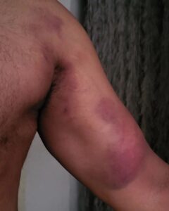 Arun Vijay Instagram - Behind all my hard-core actions you'll see on screen there are plenty of bruises like these... But still love doing my own stunts..😉 Wait for the next on screen..💪🏽 
Luv you all..❤️
#AchchamEnbadhuIllayae 
#actorslife #nothingcanstop