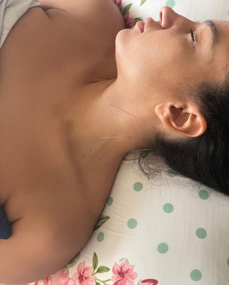 Elena Roxana Maria Fernandes Instagram - Had a great dry-needling session with Dr @payal.dalal to get rid of my migraines. Thank you for fixing me. Dry needling is an invasive procedure where a acupuncture needle is inserted into the skin and muscle. It is aimed to release the hyperirritable spots in skeletal muscle which results in forming a nodule or a taut band. . . . #dryneedling #session #relax #fix #migraine #care #health #healthy #fix #relaxation #acupuncture #painrelief #back #neck #happy #happiness #smile #love #skin #motivation #therapy #fit #physiotherapy