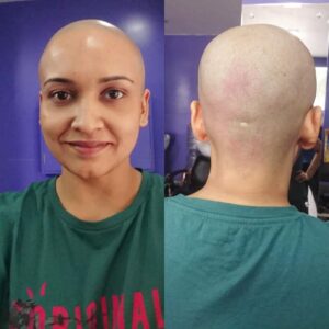 Lena Kumar Instagram - When my hair was shaved off we found proof of ‘The Matrix’  deprogramming plug in 😁. Check the scar on the back !! 
#The #Matrix #Neo #scar #throwback