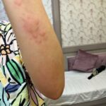 Adah Sharma Instagram - Thank u sabko...Kahan Kahan se I got messages and kuch log Jo itne saal se I haven't met also , also adah fan clubs ❤️❤️ Disclaimer :DO NOT SWIPE IF YOU ARE SCARED OF RASH ON SKIN IMAGES ,thode daravne photos hai 😬but i thought sirf Sundar pics share nahi karne chahiye on instagram na 😅 I've been bimaar kuch din se. Hives aa gaye. Hives yeh horrible rash hai. Toh full sleeves pehen ke hide kar rahi thi..chehere pe aa gaye. Stress se ! So then I took dawai and turns out main allergic hu to the dawai so lots and lots of ulti ho gayi . Toh now ek doosri dawai aur injection leke , full sleeves aur pairon ko cover karke i will do promotions today. Iske baad I promised my Amma I will take care of health. Toh kal,I'm leaving for a few days. Amma ne kaha hai radio trails, zoom interviews , promo shoot sab ho gaya ab health pe dhyaan do. I'm going to do an ayurvedic treatment. I will be back soon. Tab Tak insta pe update karti rahoongi behind the scenes Commando ke . Bhavana Reddy ko Reddy hona next project yehich mahina start horaaah.woh Kya bolthe finger cross ...apna lao continue karke dena ❤️