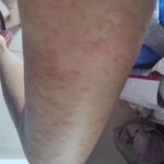 Adah Sharma Instagram - Thank u sabko...Kahan Kahan se I got messages and kuch log Jo itne saal se I haven't met also , also adah fan clubs ❤️❤️ Disclaimer :DO NOT SWIPE IF YOU ARE SCARED OF RASH ON SKIN IMAGES ,thode daravne photos hai 😬but i thought sirf Sundar pics share nahi karne chahiye on instagram na 😅 I've been bimaar kuch din se. Hives aa gaye. Hives yeh horrible rash hai. Toh full sleeves pehen ke hide kar rahi thi..chehere pe aa gaye. Stress se ! So then I took dawai and turns out main allergic hu to the dawai so lots and lots of ulti ho gayi . Toh now ek doosri dawai aur injection leke , full sleeves aur pairon ko cover karke i will do promotions today. Iske baad I promised my Amma I will take care of health. Toh kal,I'm leaving for a few days. Amma ne kaha hai radio trails, zoom interviews , promo shoot sab ho gaya ab health pe dhyaan do. I'm going to do an ayurvedic treatment. I will be back soon. Tab Tak insta pe update karti rahoongi behind the scenes Commando ke . Bhavana Reddy ko Reddy hona next project yehich mahina start horaaah.woh Kya bolthe finger cross ...apna lao continue karke dena ❤️