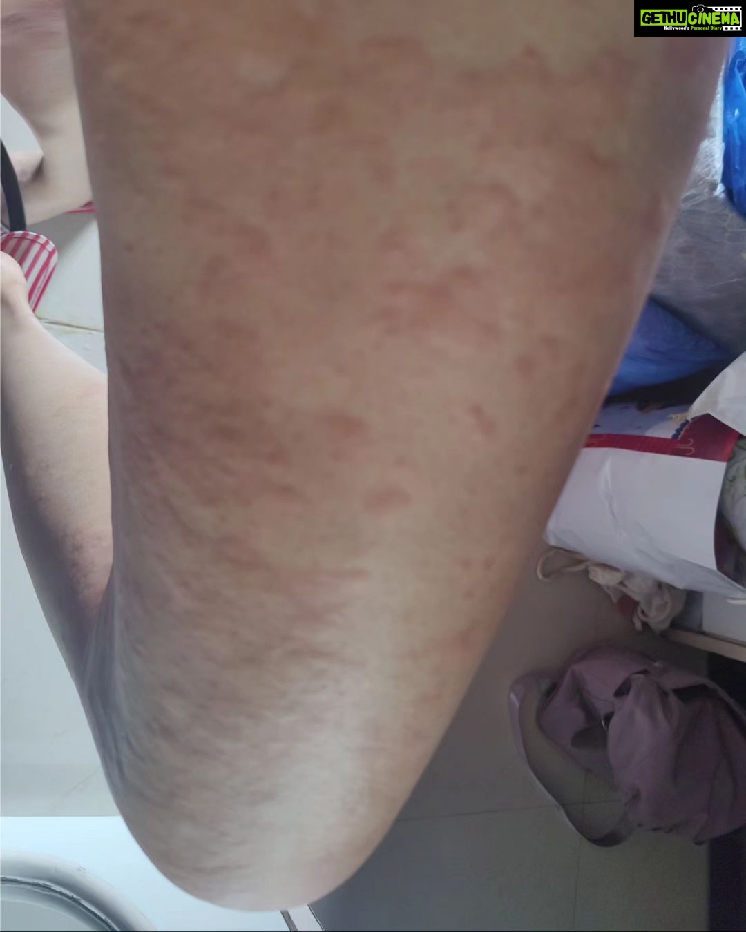 Adah Sharma Instagram - Thank u sabko...Kahan Kahan se I got messages and kuch log Jo itne saal se I haven't met also , also adah fan clubs ❤️❤️ Disclaimer :DO NOT SWIPE IF YOU ARE SCARED OF RASH ON SKIN IMAGES ,thode daravne photos hai 😬but i thought sirf Sundar pics share nahi karne chahiye on instagram na 😅 I've been bimaar kuch din se. Hives aa gaye. Hives yeh horrible rash hai. Toh full sleeves pehen ke hide kar rahi thi..chehere pe aa gaye. Stress se ! So then I took dawai and turns out main allergic hu to the dawai so lots and lots of ulti ho gayi . Toh now ek doosri dawai aur injection leke , full sleeves aur pairon ko cover karke i will do promotions today. Iske baad I promised my Amma I will take care of health. Toh kal,I'm leaving for a few days. Amma ne kaha hai radio trails, zoom interviews , promo shoot sab ho gaya ab health pe dhyaan do. I'm going to do an ayurvedic treatment. I will be back soon. Tab Tak insta pe update karti rahoongi behind the scenes Commando ke . Bhavana Reddy ko Reddy hona next project yehich mahina start horaaah.woh Kya bolthe finger cross ...apna lao continue karke dena ❤️