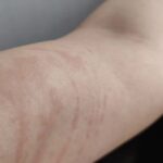 Adah Sharma Instagram - Thank u sabko...Kahan Kahan se I got messages and kuch log Jo itne saal se I haven't met also , also adah fan clubs ❤️❤️ Disclaimer :DO NOT SWIPE IF YOU ARE SCARED OF RASH ON SKIN IMAGES ,thode daravne photos hai 😬but i thought sirf Sundar pics share nahi karne chahiye on instagram na 😅 I've been bimaar kuch din se. Hives aa gaye. Hives yeh horrible rash hai. Toh full sleeves pehen ke hide kar rahi thi..chehere pe aa gaye. Stress se ! So then I took dawai and turns out main allergic hu to the dawai so lots and lots of ulti ho gayi . Toh now ek doosri dawai aur injection leke , full sleeves aur pairon ko cover karke i will do promotions today. Iske baad I promised my Amma I will take care of health. Toh kal,I'm leaving for a few days. Amma ne kaha hai radio trails, zoom interviews , promo shoot sab ho gaya ab health pe dhyaan do. I'm going to do an ayurvedic treatment. I will be back soon. Tab Tak insta pe update karti rahoongi behind the scenes Commando ke . Bhavana Reddy ko Reddy hona next project yehich mahina start horaaah.woh Kya bolthe finger cross ...apna lao continue karke dena ❤️
