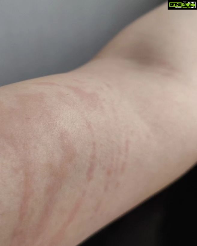 Adah Sharma Instagram - Thank u sabko...Kahan Kahan se I got messages and kuch log Jo itne saal se I haven't met also , also adah fan clubs ❤️❤️ Disclaimer :DO NOT SWIPE IF YOU ARE SCARED OF RASH ON SKIN IMAGES ,thode daravne photos hai 😬but i thought sirf Sundar pics share nahi karne chahiye on instagram na 😅 I've been bimaar kuch din se. Hives aa gaye. Hives yeh horrible rash hai. Toh full sleeves pehen ke hide kar rahi thi..chehere pe aa gaye. Stress se ! So then I took dawai and turns out main allergic hu to the dawai so lots and lots of ulti ho gayi . Toh now ek doosri dawai aur injection leke , full sleeves aur pairon ko cover karke i will do promotions today. Iske baad I promised my Amma I will take care of health. Toh kal,I'm leaving for a few days. Amma ne kaha hai radio trails, zoom interviews , promo shoot sab ho gaya ab health pe dhyaan do. I'm going to do an ayurvedic treatment. I will be back soon. Tab Tak insta pe update karti rahoongi behind the scenes Commando ke . Bhavana Reddy ko Reddy hona next project yehich mahina start horaaah.woh Kya bolthe finger cross ...apna lao continue karke dena ❤️
