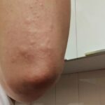 Adah Sharma Instagram - Thank u sabko...Kahan Kahan se I got messages and kuch log Jo itne saal se I haven't met also , also adah fan clubs ❤️❤️ Disclaimer :DO NOT SWIPE IF YOU ARE SCARED OF RASH ON SKIN IMAGES ,thode daravne photos hai 😬but i thought sirf Sundar pics share nahi karne chahiye on instagram na 😅 I've been bimaar kuch din se. Hives aa gaye. Hives yeh horrible rash hai. Toh full sleeves pehen ke hide kar rahi thi..chehere pe aa gaye. Stress se ! So then I took dawai and turns out main allergic hu to the dawai so lots and lots of ulti ho gayi . Toh now ek doosri dawai aur injection leke , full sleeves aur pairon ko cover karke i will do promotions today. Iske baad I promised my Amma I will take care of health. Toh kal,I'm leaving for a few days. Amma ne kaha hai radio trails, zoom interviews , promo shoot sab ho gaya ab health pe dhyaan do. I'm going to do an ayurvedic treatment. I will be back soon. Tab Tak insta pe update karti rahoongi behind the scenes Commando ke . Bhavana Reddy ko Reddy hona next project yehich mahina start horaaah.woh Kya bolthe finger cross ...apna lao continue karke dena ❤️