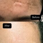 Chinmayi Instagram - Surgical scar revision followed by CO2 laser resurfacing performed at @deepskindialogues - pictures taken six months apart. Procedure is performed under local anaesthesia and patient is extremely comfortable during and after the surgery and while undergoing laser. Scar revision surgeries and laser resurfacing does not erase a scar but helps to make it less noticeable. An understanding of anatomy, wound healing along with experience, meticulous planning and surgical techniques can reduce complications and help improve the outcome. #scar #revisionnotremoval #scarrevision #suture #laser #CO2 #resurfacing #forehead #anatomy #dermatology #dermatosurgeon #lifeofadermatologist #deepskindialogues #chinmayi #dr.kumudhini #dr.kumudhini_skindoc