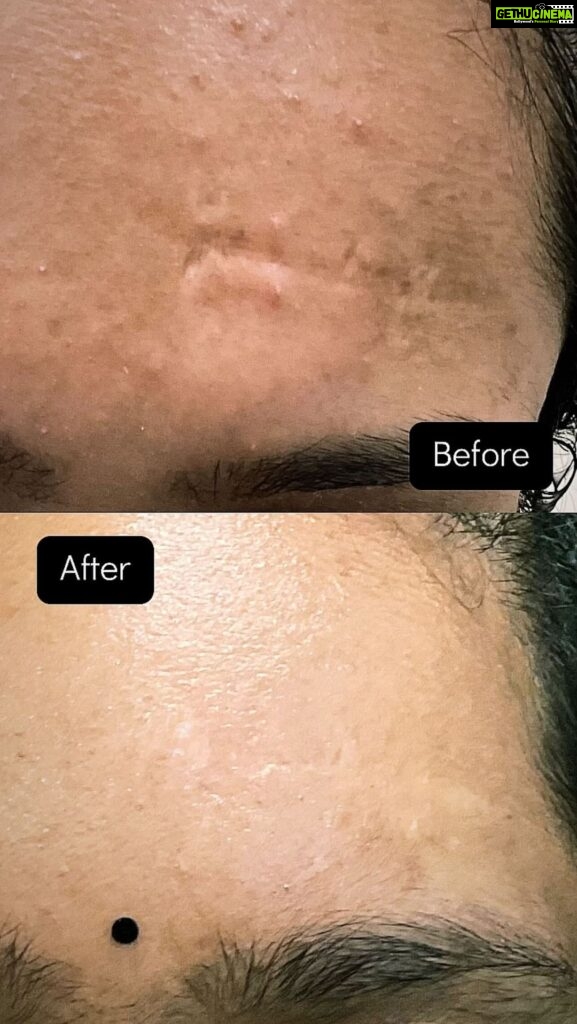 Chinmayi Instagram - Surgical scar revision followed by CO2 laser resurfacing performed at @deepskindialogues - pictures taken six months apart. Procedure is performed under local anaesthesia and patient is extremely comfortable during and after the surgery and while undergoing laser. Scar revision surgeries and laser resurfacing does not erase a scar but helps to make it less noticeable. An understanding of anatomy, wound healing along with experience, meticulous planning and surgical techniques can reduce complications and help improve the outcome. #scar #revisionnotremoval #scarrevision #suture #laser #CO2 #resurfacing #forehead #anatomy #dermatology #dermatosurgeon #lifeofadermatologist #deepskindialogues #chinmayi #dr.kumudhini #dr.kumudhini_skindoc