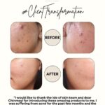 Chinmayi Instagram - The kind of DMs we absolutely LOVE. This wonderful transformation is a result of a carefully curated skincare routine that is customised to the individual’s skintype and skin concerns and followed with consistency! The results speak for themself :) #skincare #skincareroutine #beforeandafter #curatedskincare #skintransformation