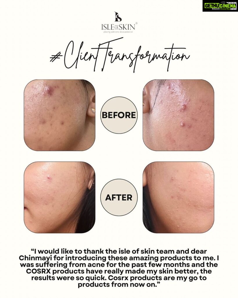Chinmayi Instagram - The kind of DMs we absolutely LOVE. This wonderful transformation is a result of a carefully curated skincare routine that is customised to the individual’s skintype and skin concerns and followed with consistency! The results speak for themself :) #skincare #skincareroutine #beforeandafter #curatedskincare #skintransformation