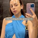 Nitibha Kaul Instagram – Simply healing acne is not enough. Post acne skin comes with a lot of trauma- bumps, redness, scars, enlarged pores & uneven skin texture. Thats why this phase was crucial in ensuring my skin looks the way it is today. Its a slow process, probably slower than healing the acne itself, but if treatments are taken at the right time along with following a good & consistent routine + basic lifestyle changes- YOU CAN GET YOUR SKIN BACK ♥️ If I can, so can you. 

All my treatments were done at @potenzawellness by @drjayapathakofficial & at @medlinksaesthetics by @drpankajchaturvedi_md (not sponsored)