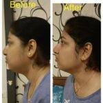Gauri Pradhan Tejwani Instagram – Progress in 10 sessions.
#OorjaByGauri #faceyoga #transformation #pranayama
New face yoga batches starting from tomorrow, 12th of June