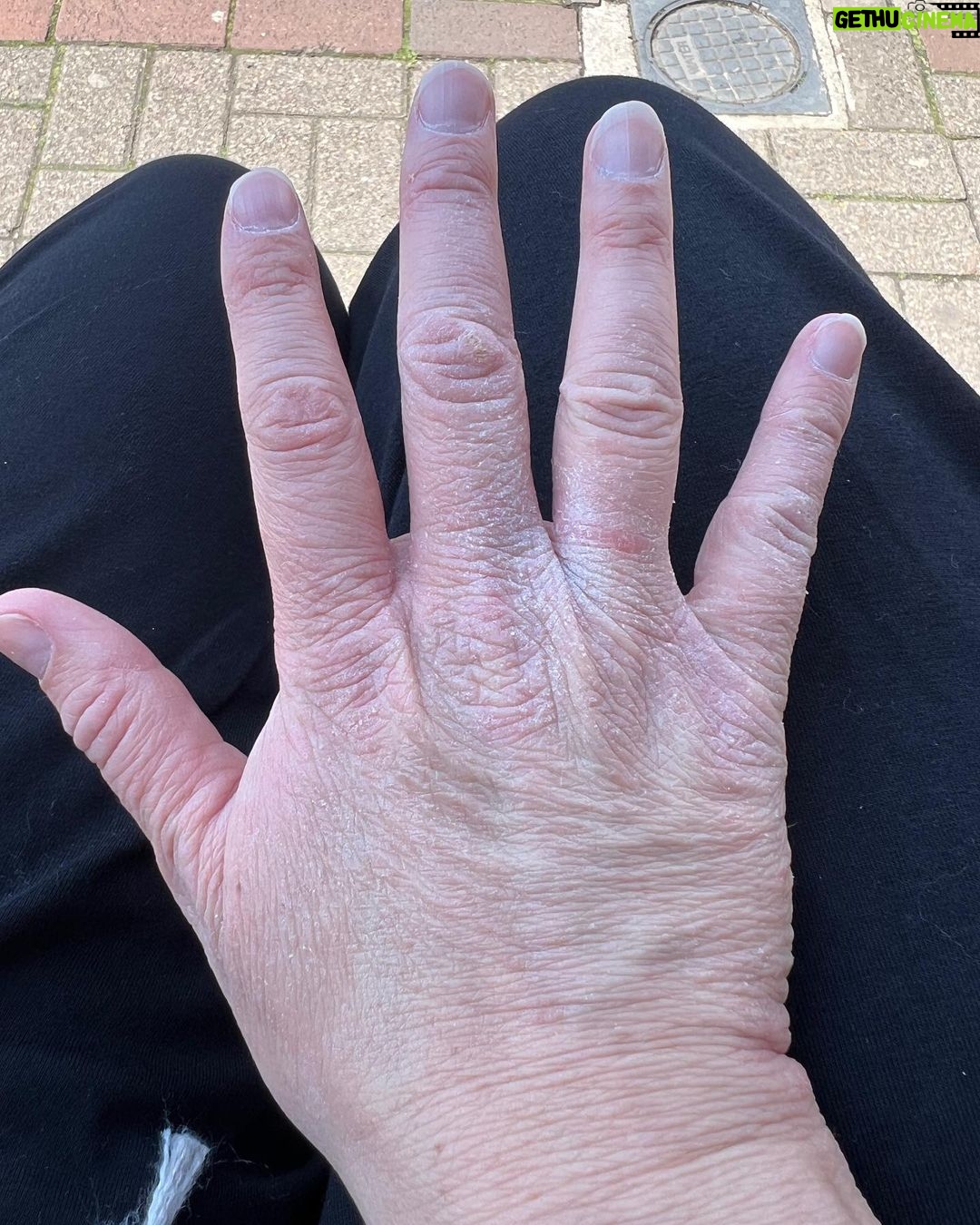 Ali Bastian Instagram - There’s no doubt about it, we are an atopic family… I’ve had eczema for as long as I can remember and my little girl Isla has eczema and multiple severe food allergies. Being an allergy Mamma I’m washing my hands constantly when preparing food or when coming into contact with any of Isla’s allergens. As a result, my hands have such bad eczema flares… At times they even crack and bleed. I feel so self conscious about it and I know amongst other things, it can look so ageing! I was previously prescribed @doublebaseuk by my Dr and find it brilliant for the day to day management of my eczema. I have recently discovered Doublebase Dry Skin Hand Wash and thought I would put it to the test for seven days by replacing my usual soap. I also used Doublebase Dry Skin Emollient after washing my hands. Have a swipe through my photos to see the results!! At the beginning of the week my hands were so dry and cracked… full disclosure, I’m a busy Mamma and I didn’t manage to use the emollient EVERY time but having the intention meant I did it SOME of the time which was enough to make a huge difference. Anyone with eczema knows there aren’t many quick fixes and consistency is key but already my hands are softer, no more painful cracks in the skin and looking younger already! Doublebase Dry Skin Hand Wash is definitely going to be part of my eczema care routine moving forward and what’s also fab is that @Doublebaseuk products are easier to get hold of from places such as Boots. #Doublebase #Eczema #Psoriasis #Dermatitis #Doublebasedifference #AD