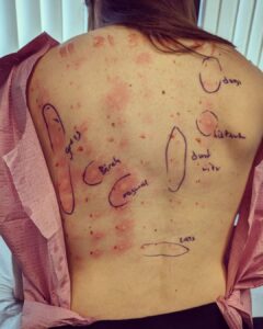 Alison Haislip Instagram - WARNING: Swipe ONLY if you want to see how allergic I am to the outdoors. Turns out, I'm allergic to basically all trees and grass. And while I've always had mild allergies, the ungodly rain SoCal had at the beginning of the year has triggered an allergy in me like I have never known...I have absolutely NO sinus issues, but if I don't take an antihistamine every other day, I break out in hives. It's insane. So if @zyrtecallergy is looking to sponsor someone this allergy season, I'd love to throw my hat in the ring. (Oh and don't worry about that tiny circle that says dogs up in the corner. That's only a mild allergy. Thankfully I can still snuggle all doggos.)