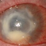 Andrew Neighbors Instagram - It’s that time of year again! I get a lot of people asking about costume contact lenses. Generally I’d say skip them, they aren’t worth the risk (see the corneal ulcer on the last slide that can cause permanent scarring /blindness from an incorrectly worn contact lens) But if you reallllyyyy wanna wear them, they still need to be fitted and checked by an optometrist. If the doctor isn’t sure of any brands, I’ve had some luck with the “gothika” website/brand. But they NEED to be done by your eye doctor!! Stay safe and protect ur eyeballs.