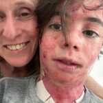 Deborah Colker Instagram - A EB (epidermólise bolhosa) ainda não tem cura. Mas existe no afeto e no cuidado a cura do que não tem cura. Vamos abraçar essas crianças e lutar pelos tratamentos possíveis. Que maravilha conseguir enxergar nessa cena do menino Gui com o presidente Lula uma oportunidade de visibilidade para as doenças raras. Na segunda foto eu e meu neto theo, que tem a mesma condição genética que o Gui (epidermólise bolhosa). #eb #epidermolisebolhosa #doençasraras