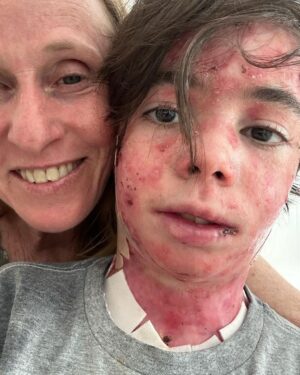 Deborah Colker Instagram - A EB (epidermólise bolhosa) ainda não tem cura. Mas existe no afeto e no cuidado a cura do que não tem cura. Vamos abraçar essas crianças e lutar pelos tratamentos possíveis. 

Que maravilha conseguir enxergar nessa cena do menino Gui com o presidente Lula uma oportunidade de visibilidade para as doenças raras. 

Na segunda foto eu e meu neto theo, que tem a mesma condição genética que o Gui (epidermólise bolhosa).

#eb #epidermolisebolhosa #doençasraras