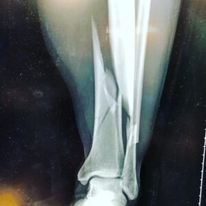 Eaddy Mays Instagram - OK, so I’m starting this post with a really goofy picture of me so that if you are easily grossed out or have a weak stomach DO NOT look at any more pictures in this post. Got it?!! I totally did an @spiderandersonsilva 😣 The pix are kinda gross (but I think it’s cool LOL so I’m sharing it with you.) Also,  I’m looking for Sci-Fi reading recommendations! Put ‘em in the comments, please. Ok. Be smart (smarter than me! LOLOL) and we’ll connect soon 😘😘😘