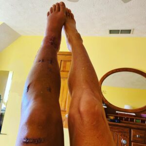 Eaddy Mays Instagram - OK, so I’m starting this post with a really goofy picture of me so that if you are easily grossed out or have a weak stomach DO NOT look at any more pictures in this post. Got it?!! I totally did an @spiderandersonsilva 😣 The pix are kinda gross (but I think it’s cool LOL so I’m sharing it with you.) Also,  I’m looking for Sci-Fi reading recommendations! Put ‘em in the comments, please. Ok. Be smart (smarter than me! LOLOL) and we’ll connect soon 😘😘😘