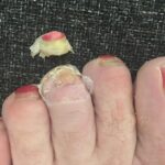 Eddie Izzard Instagram - Almost 36 miles run so far today on 'double marathon Sunday'. And with a toe that looks like this... #MakeHumanityGreatAgain eddieizzard.com - The Beekeepers