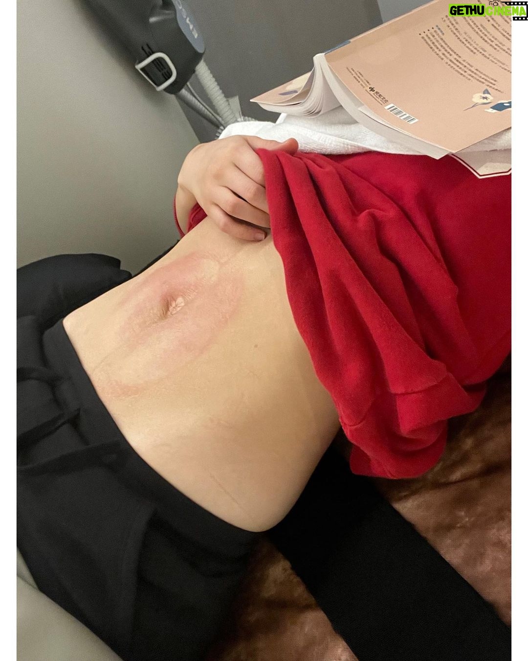Esther Yang - 3.5K Likes - 在有孩子之前,
我從沒想過需要動用醫療級儀器幫忙減脂緊實這回事,
只是生完已經一年多,肚子還是超大一顆,
二胎後肚皮超鬆,跟上面那層脂肪….
即便縮小腹縮到快斷氣,
沒穿束腹,別人還是會不小心以為我又懷孕了,
忍住少吃,加上一週運動兩次,
擁有平坦的小腹,仍是媽媽遙不可及的夢想啊~~~~
所以我考慮了很久,還是去做了!
日前大家有看到我限動分享去 @louvre8890 做〈Emsculpt Neo熱磁減脂療程〉,
全都心癢癢的私訊問我,「到底效果如何?」
我很誠實地說,「本人非常滿意~」
跟一般居家用的EMS很不一樣,
它擁有歐盟CE、美國FDA 、台灣TFDA三大認證,
在全球已經超過1百萬人次使用,
是最新一代的雙科技熱磁結合技術,
用熱能破壞皮下脂肪細胞,
加上高強度的聚焦磁能,
去讓身體達到增肌、減脂加緊實的效果!
第一次做的時候,
就能明顯感受到肌肉深層的作用,
療程中腹肌整個不斷被拔起來,
因為還有熱能加持,做完肚子全!是!汗!
哈哈哈哈不愧是連續2年榮獲全球醫美大賞的最佳體雕儀器,
媽媽完全驚呆了~ 😲
看著自己腰圍一次比一次小,
肚皮也變得緊實,真的很有成就感!
另外有趣的是,教練竟然誇我運動時核心變穩定了,
像我這種體能低下、肌肉含量少的小弱腳,
運動經常還沒操到長到肌肉的部分就已經無力了,
可這個療程每次不過區區30分鐘,
就相當於幫我做了20,000次的仰臥起坐,
這強度絕對非我自己一般自主鍛鍊做得到的啊~~
後來每次去,
都請護理長幫我把level儘速催到90+,
實在一分一秒都不想浪費它的功效!🤣
@musoonclinic 的合作夥伴 @louvre8890 ,
除了有經過肥胖醫學會的減重門診醫生提供療程建議,
更有專業營養師給予飲食上的指引,
幫助產後婦女們讓身體由內而外的健康自信起來!💪🏻
#NEO熱磁減脂 ,可以說是今年我送給自己最好的禮物~
那天意外看到有人分享,
原來佛朗明哥紅鶴在餵養小紅鶴時,
自己粉紅色的毛會慢慢退色,
一旦那段日子結束,
毛的顏色又會再度長回來。
我是真心相信,
Ladies, we’ll get our pink back! 🦩
#熱磁減脂 #emsculptneo #羅浮婦女診所 #原廠認證診所 #木生婦幼診所