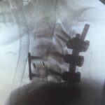 George Robinson Instagram - So today is Spinal Cord Injury Awareness Day. I’ve always found days like this to be a bit odd. They are a period to look back at how far I’ve come, personally, but an opportunity also to look around at the fantastic community that I have discovered since my injury. Wonderful charities such as @backuptrust @aspirecharity @spinal_injuries @hambofoundation do so much incredible work to demonstrate that living a fulfilled life is certainly possible after a spinal cord injury. It can almost see in like an insurmountable goal initially after the injury but days like this help you remember that there is a community that will always lift you and inspire you to achieve great things.