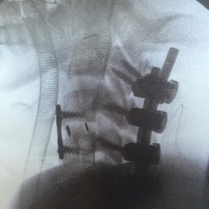 George Robinson Instagram - So today is Spinal Cord Injury Awareness Day. I’ve always found days like this to be a bit odd. They are a period to look back at how far I’ve come, personally, but an opportunity also to look around at the fantastic community that I have discovered since my injury. Wonderful charities such as @backuptrust @aspirecharity @spinal_injuries @hambofoundation do so much incredible work to demonstrate that living a fulfilled life is certainly possible after a spinal cord injury. 
It can almost see in like an insurmountable goal initially after the injury but days like this help you remember that there is a community that will always lift you and inspire you to achieve great things.