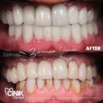Jardel Instagram - Beyond thrilled to have trusted CINIK Dental for my smile transformation! Just had my zirconium crown treatment and WOW, the results are truly incredible! The team at @cinikdentalturkey is absolutely top-notch, providing the highest level of care and expertise. If you're looking for a game-changing dental experience, I highly recommend CINIK Dental! Thank you @dr.emrahcinik