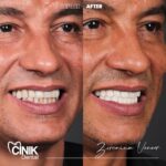 Jardel Instagram - Beyond thrilled to have trusted CINIK Dental for my smile transformation! Just had my zirconium crown treatment and WOW, the results are truly incredible! The team at @cinikdentalturkey is absolutely top-notch, providing the highest level of care and expertise. If you're looking for a game-changing dental experience, I highly recommend CINIK Dental! Thank you @dr.emrahcinik