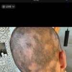 Jordan Haj Instagram – Ze 100% zarostlá ALOPECIE zítra 13:30 Q&A a livestream s Dr. Která mi to vyléčila. O léčbě co jsem absolvoval já, o tom jestli je to jistota, když to zkusíš léčit stejně, a o dalších možnostech léčby. Už delší dobu mi denodenně chodí dotazy na téma alopecie a já se snažím odpovídat svemdomitě ale vlastně na většinu otázek eridované odpovědi samozřejmě nemám.  Budu zítra (neboli dnes, v pondělí 19.6.) Na kontrole u paní doktorkorky @monika_arenbergerova ve vinohradské nemocnici a poprosil jsem ji, jestli by se mnou neudělala livestream ke kterému by se mohli připojit ti, co mi píší dotazy a dostat odpovědi připmo od ní. zkusím to tu pak uložit s co nejobsáhlejším pokrytím toho jak jsem to k současnému úspěchu(snad na co nejdéle trvajícímu) absolvoval pod jejím dozorem a péčí já.