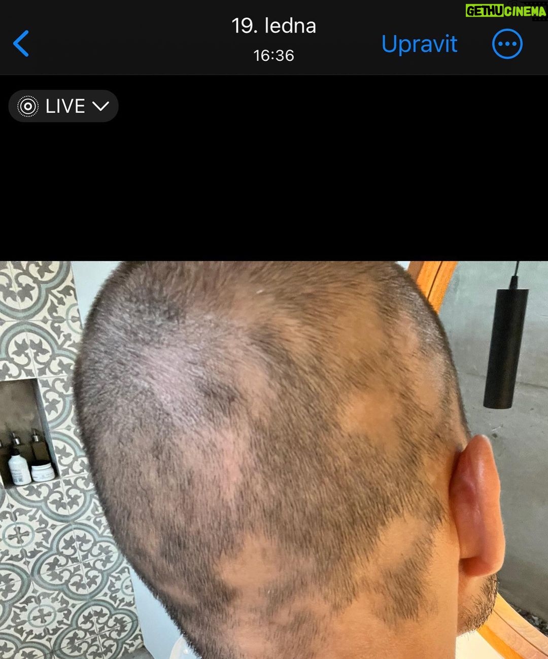 Jordan Haj Instagram - Ze 100% zarostlá ALOPECIE zítra 13:30 Q&A a livestream s Dr. Která mi to vyléčila. O léčbě co jsem absolvoval já, o tom jestli je to jistota, když to zkusíš léčit stejně, a o dalších možnostech léčby. Už delší dobu mi denodenně chodí dotazy na téma alopecie a já se snažím odpovídat svemdomitě ale vlastně na většinu otázek eridované odpovědi samozřejmě nemám. Budu zítra (neboli dnes, v pondělí 19.6.) Na kontrole u paní doktorkorky @monika_arenbergerova ve vinohradské nemocnici a poprosil jsem ji, jestli by se mnou neudělala livestream ke kterému by se mohli připojit ti, co mi píší dotazy a dostat odpovědi připmo od ní. zkusím to tu pak uložit s co nejobsáhlejším pokrytím toho jak jsem to k současnému úspěchu(snad na co nejdéle trvajícímu) absolvoval pod jejím dozorem a péčí já.