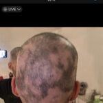 Jordan Haj Instagram – Ze 100% zarostlá ALOPECIE zítra 13:30 Q&A a livestream s Dr. Která mi to vyléčila. O léčbě co jsem absolvoval já, o tom jestli je to jistota, když to zkusíš léčit stejně, a o dalších možnostech léčby. Už delší dobu mi denodenně chodí dotazy na téma alopecie a já se snažím odpovídat svemdomitě ale vlastně na většinu otázek eridované odpovědi samozřejmě nemám.  Budu zítra (neboli dnes, v pondělí 19.6.) Na kontrole u paní doktorkorky @monika_arenbergerova ve vinohradské nemocnici a poprosil jsem ji, jestli by se mnou neudělala livestream ke kterému by se mohli připojit ti, co mi píší dotazy a dostat odpovědi připmo od ní. zkusím to tu pak uložit s co nejobsáhlejším pokrytím toho jak jsem to k současnému úspěchu(snad na co nejdéle trvajícímu) absolvoval pod jejím dozorem a péčí já.