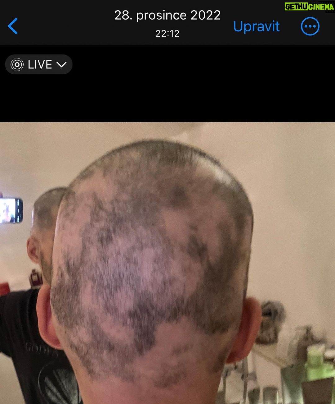 Jordan Haj Instagram - Ze 100% zarostlá ALOPECIE zítra 13:30 Q&A a livestream s Dr. Která mi to vyléčila. O léčbě co jsem absolvoval já, o tom jestli je to jistota, když to zkusíš léčit stejně, a o dalších možnostech léčby. Už delší dobu mi denodenně chodí dotazy na téma alopecie a já se snažím odpovídat svemdomitě ale vlastně na většinu otázek eridované odpovědi samozřejmě nemám. Budu zítra (neboli dnes, v pondělí 19.6.) Na kontrole u paní doktorkorky @monika_arenbergerova ve vinohradské nemocnici a poprosil jsem ji, jestli by se mnou neudělala livestream ke kterému by se mohli připojit ti, co mi píší dotazy a dostat odpovědi připmo od ní. zkusím to tu pak uložit s co nejobsáhlejším pokrytím toho jak jsem to k současnému úspěchu(snad na co nejdéle trvajícímu) absolvoval pod jejím dozorem a péčí já.