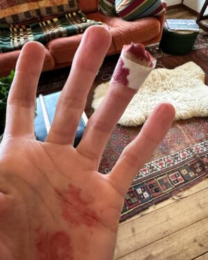 Louise Brealey Instagram - Preparation for #BAFTAs tomorrow with #brianandcharlesmovie is underway. Pedicure? Check. Allergic reaction at local salon to eyelash tint? Check. Slice finger instead of pear with bread knife like a twat? Check.