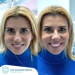 Mónica Sintra Instagram - Há uns tempos, recebemos a querida @monicasintraoficial , que se submeteu a um branqueamento, um processo que só tem vantagens: é indolor, rápido... e com resultados evidentes!
